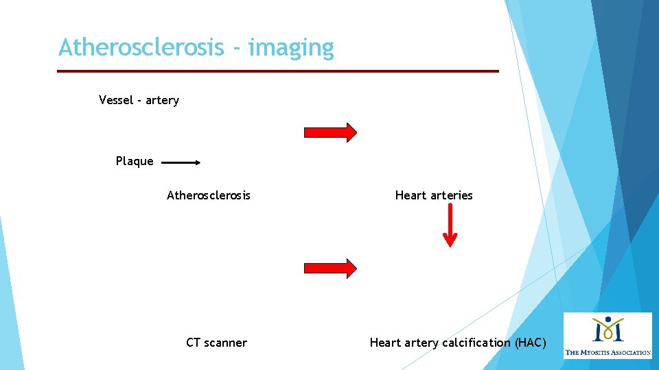 Atherosclerosis - imaging Vessel - artery Plaque Atherosclerosis CT scanner Heart arteries Heart artery