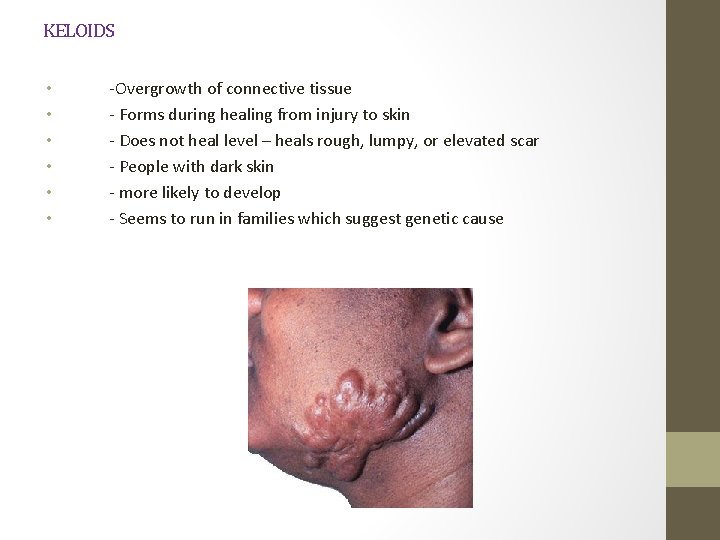 KELOIDS • • • -Overgrowth of connective tissue - Forms during healing from injury