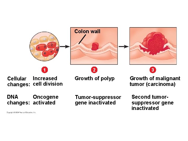 Colon wall 1 2 Cellular Increased changes: cell division Growth of polyp DNA Oncogene