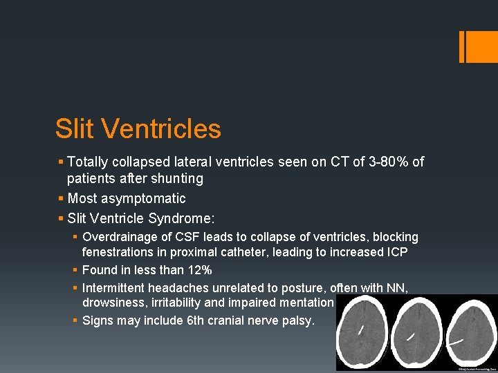 Slit Ventricles § Totally collapsed lateral ventricles seen on CT of 3 80% of