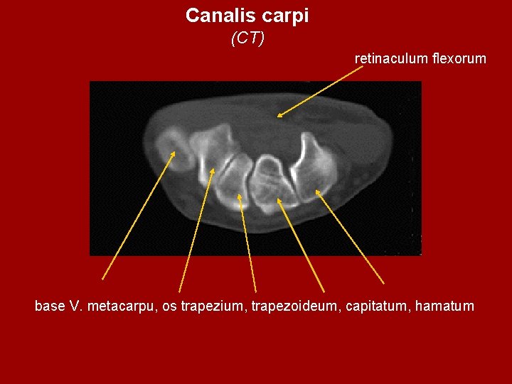 Canalis carpi (CT) retinaculum flexorum base V. metacarpu, os trapezium, trapezoideum, capitatum, hamatum 