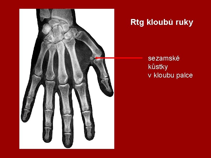 Rtg kloubů ruky sezamské kůstky v kloubu palce 