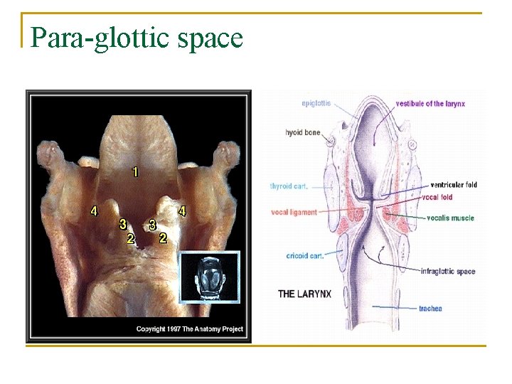 Para-glottic space 