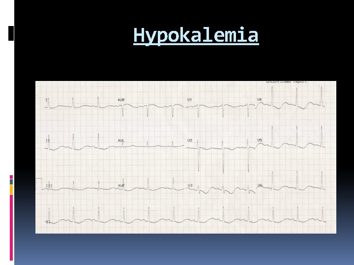 Hypokalemia 