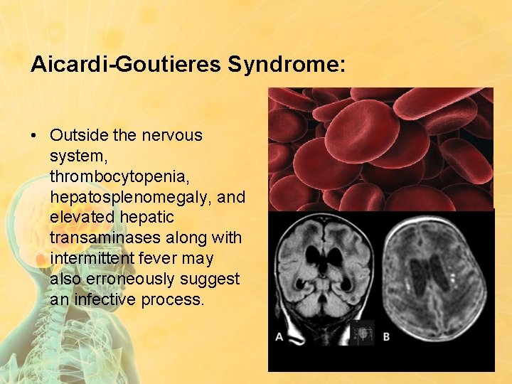 Aicardi-Goutieres Syndrome: • Outside the nervous system, thrombocytopenia, hepatosplenomegaly, and elevated hepatic transaminases along