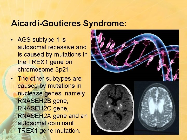 Aicardi-Goutieres Syndrome: • AGS subtype 1 is autosomal recessive and is caused by mutations