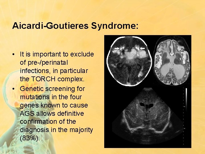 Aicardi-Goutieres Syndrome: • It is important to exclude of pre-/perinatal infections, in particular the