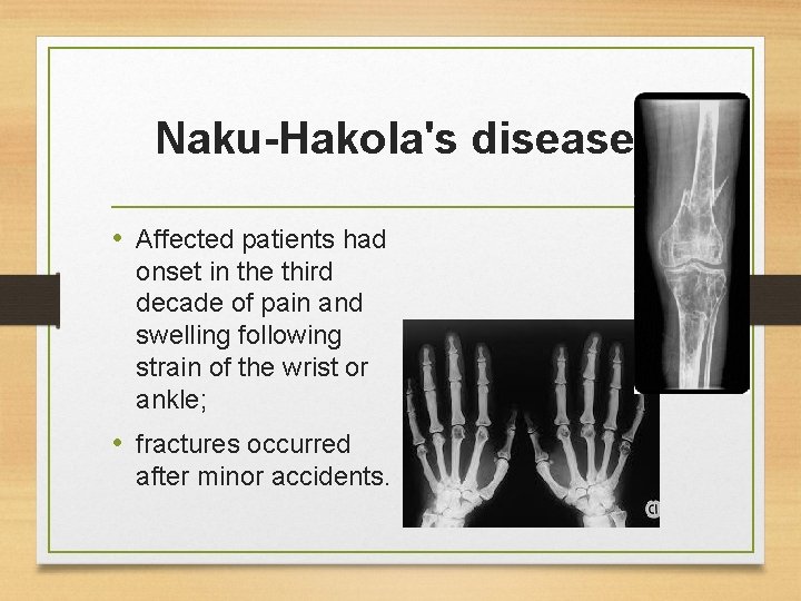 Naku-Hakola's disease: • Affected patients had onset in the third decade of pain and