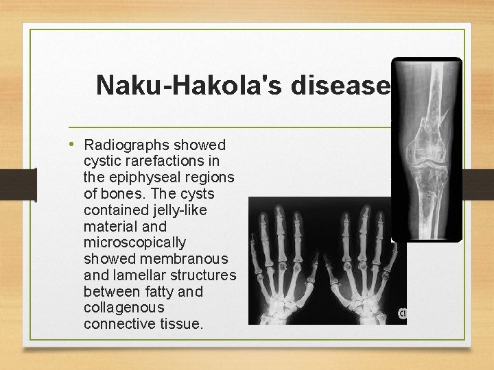 Naku-Hakola's disease: • Radiographs showed cystic rarefactions in the epiphyseal regions of bones. The