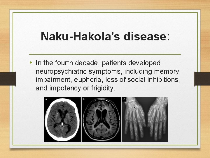 Naku-Hakola's disease: • In the fourth decade, patients developed neuropsychiatric symptoms, including memory impairment,