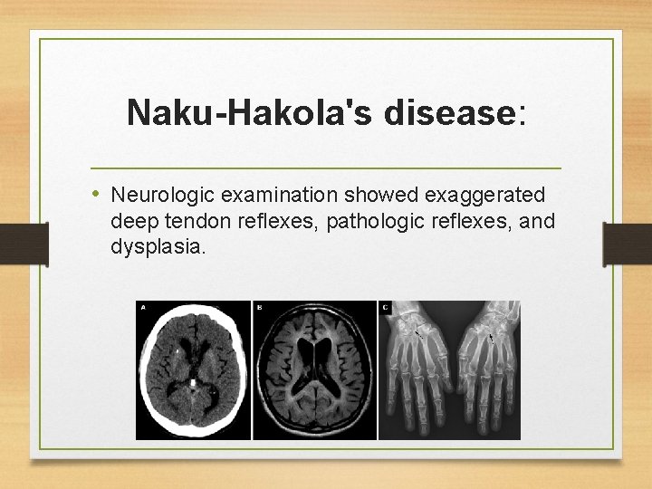 Naku-Hakola's disease: • Neurologic examination showed exaggerated deep tendon reflexes, pathologic reflexes, and dysplasia.