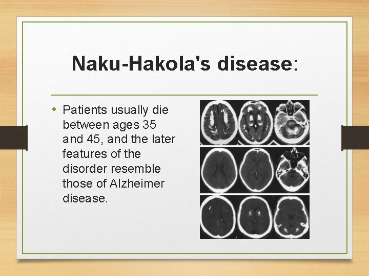 Naku-Hakola's disease: • Patients usually die between ages 35 and 45, and the later