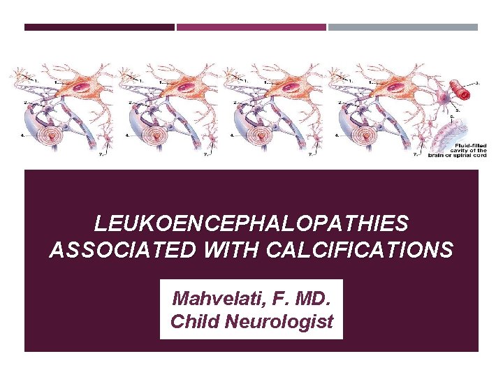 LEUKOENCEPHALOPATHIES ASSOCIATED WITH CALCIFICATIONS Mahvelati, F. MD. Child Neurologist 