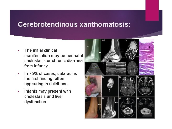 LEUKOENCEPHALOPATHIES ASSOCIATED WITH CALCIFICATIONS Mahvelati F MD Child