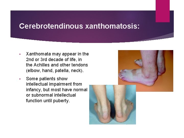 Cerebrotendinous xanthomatosis: • Xanthomata may appear in the 2 nd or 3 rd decade