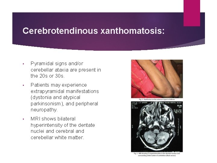 Cerebrotendinous xanthomatosis: • Pyramidal signs and/or cerebellar ataxia are present in the 20 s