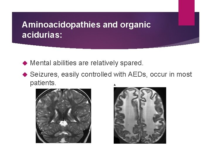 Aminoacidopathies and organic acidurias: Mental abilities are relatively spared. Seizures, easily controlled with AEDs,