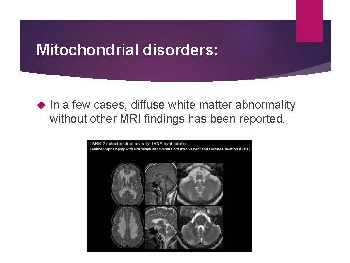 Mitochondrial disorders: In a few cases, diffuse white matter abnormality without other MRI ﬁndings