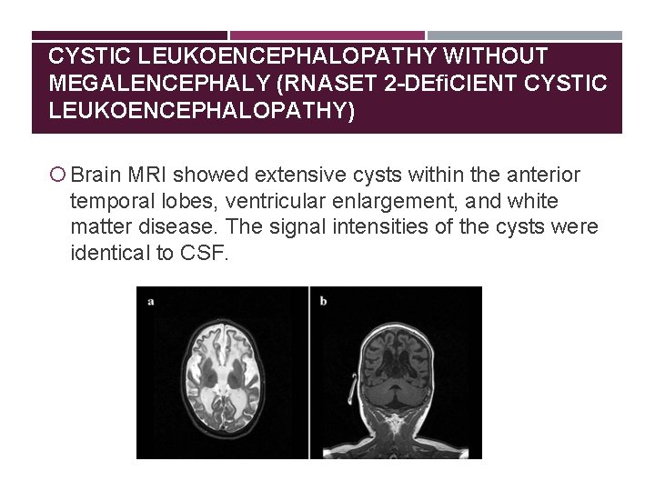 CYSTIC LEUKOENCEPHALOPATHY WITHOUT MEGALENCEPHALY (RNASET 2 -DEﬁCIENT CYSTIC LEUKOENCEPHALOPATHY) Brain MRI showed extensive cysts