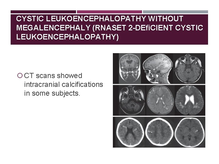 CYSTIC LEUKOENCEPHALOPATHY WITHOUT MEGALENCEPHALY (RNASET 2 -DEﬁCIENT CYSTIC LEUKOENCEPHALOPATHY) CT scans showed intracranial calcifications
