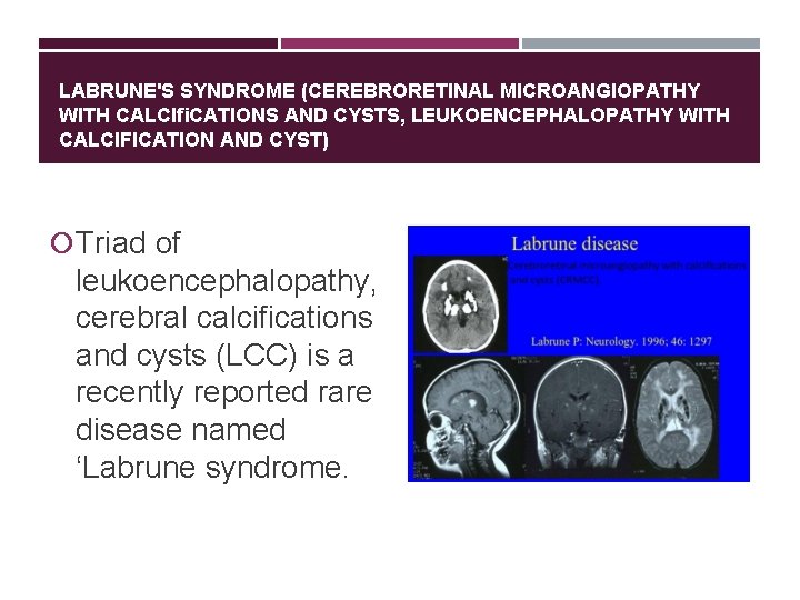LABRUNE'S SYNDROME (CEREBRORETINAL MICROANGIOPATHY WITH CALCIﬁCATIONS AND CYSTS, LEUKOENCEPHALOPATHY WITH CALCIFICATION AND CYST) Triad