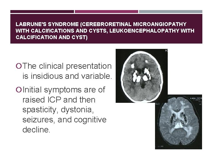 LABRUNE'S SYNDROME (CEREBRORETINAL MICROANGIOPATHY WITH CALCIﬁCATIONS AND CYSTS, LEUKOENCEPHALOPATHY WITH CALCIFICATION AND CYST) The