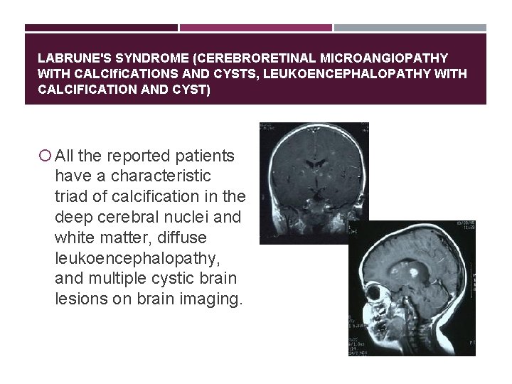 LABRUNE'S SYNDROME (CEREBRORETINAL MICROANGIOPATHY WITH CALCIﬁCATIONS AND CYSTS, LEUKOENCEPHALOPATHY WITH CALCIFICATION AND CYST) All