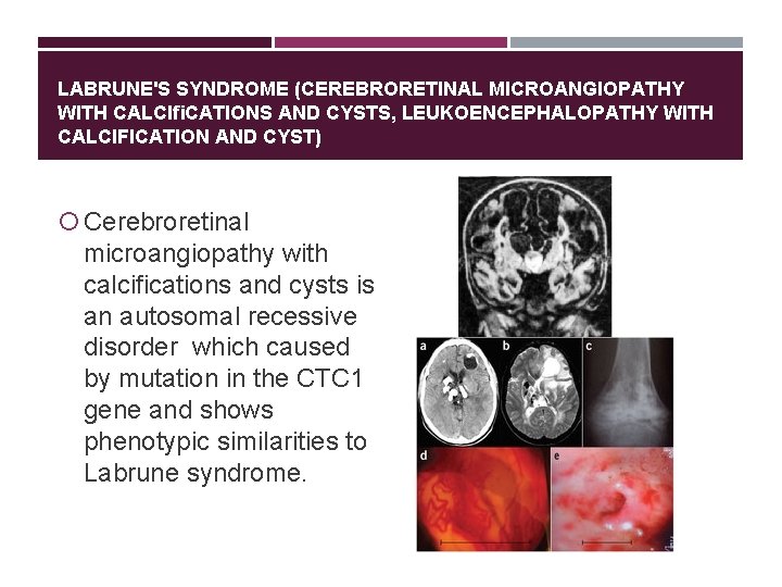 LABRUNE'S SYNDROME (CEREBRORETINAL MICROANGIOPATHY WITH CALCIﬁCATIONS AND CYSTS, LEUKOENCEPHALOPATHY WITH CALCIFICATION AND CYST) Cerebroretinal