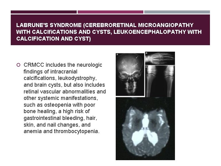 LABRUNE'S SYNDROME (CEREBRORETINAL MICROANGIOPATHY WITH CALCIﬁCATIONS AND CYSTS, LEUKOENCEPHALOPATHY WITH CALCIFICATION AND CYST) CRMCC