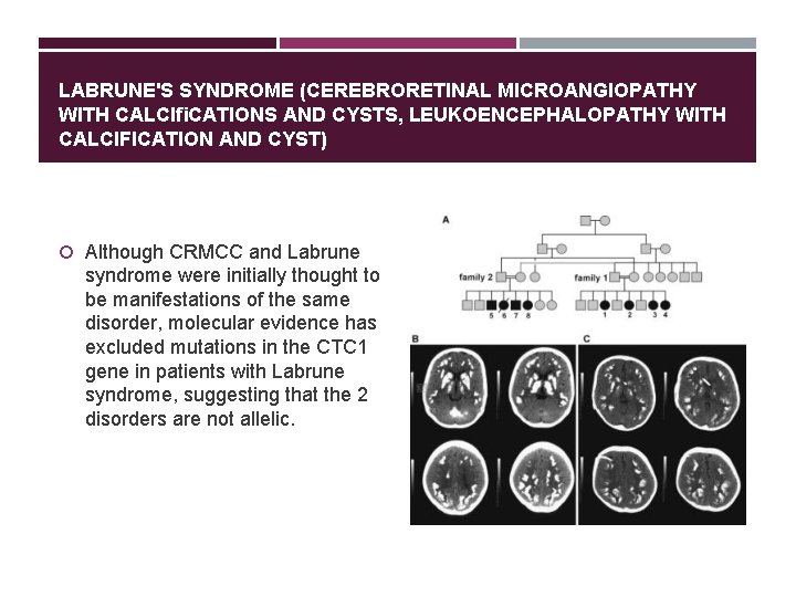 LABRUNE'S SYNDROME (CEREBRORETINAL MICROANGIOPATHY WITH CALCIﬁCATIONS AND CYSTS, LEUKOENCEPHALOPATHY WITH CALCIFICATION AND CYST) Although