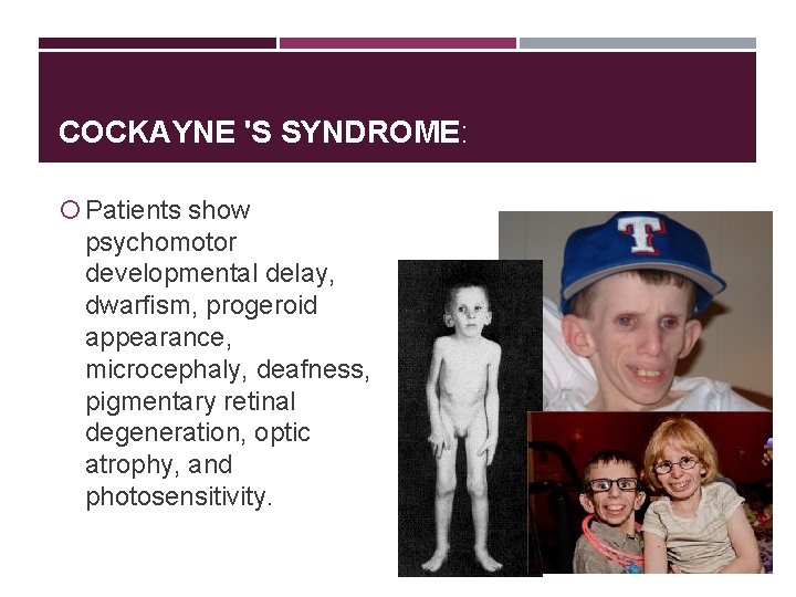 COCKAYNE 'S SYNDROME: Patients show psychomotor developmental delay, dwarﬁsm, progeroid appearance, microcephaly, deafness, pigmentary