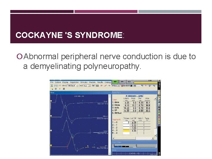 COCKAYNE 'S SYNDROME: Abnormal peripheral nerve conduction is due to a demyelinating polyneuropathy. 