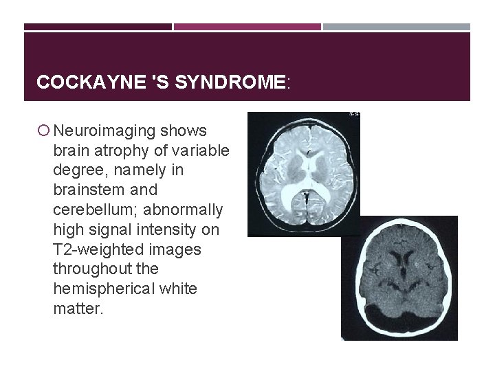 COCKAYNE 'S SYNDROME: Neuroimaging shows brain atrophy of variable degree, namely in brainstem and