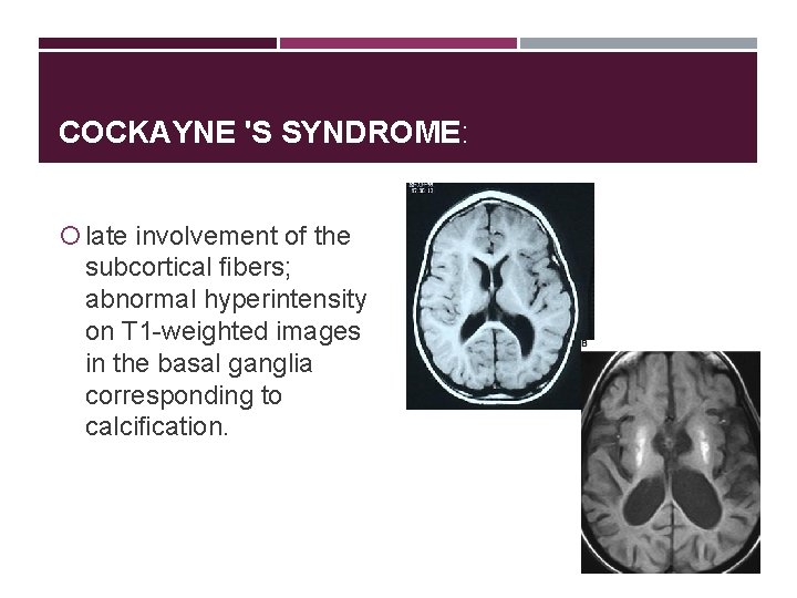COCKAYNE 'S SYNDROME: late involvement of the subcortical ﬁbers; abnormal hyperintensity on T 1