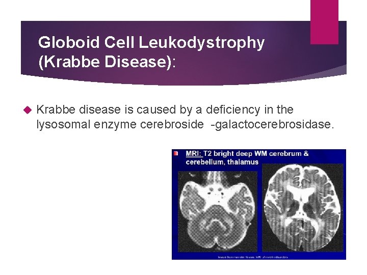 Globoid Cell Leukodystrophy (Krabbe Disease): Krabbe disease is caused by a deﬁciency in the