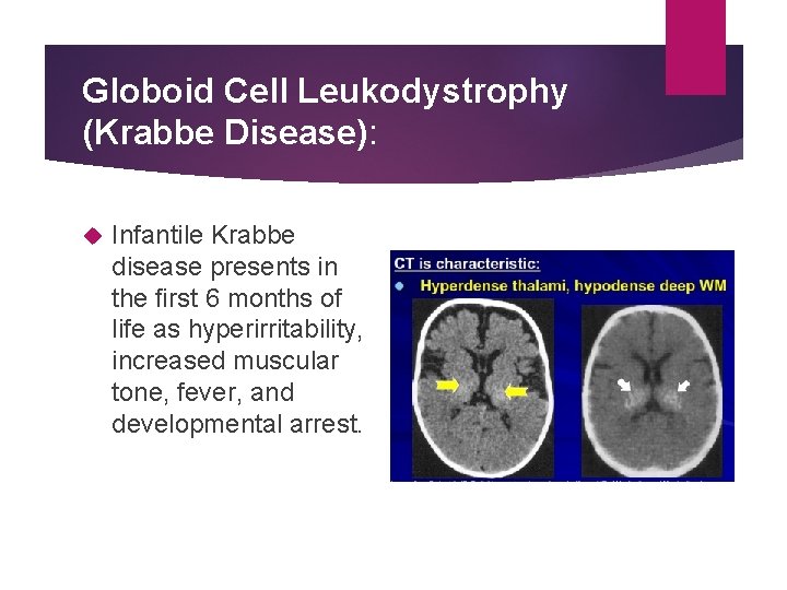 Globoid Cell Leukodystrophy (Krabbe Disease): Infantile Krabbe disease presents in the ﬁrst 6 months