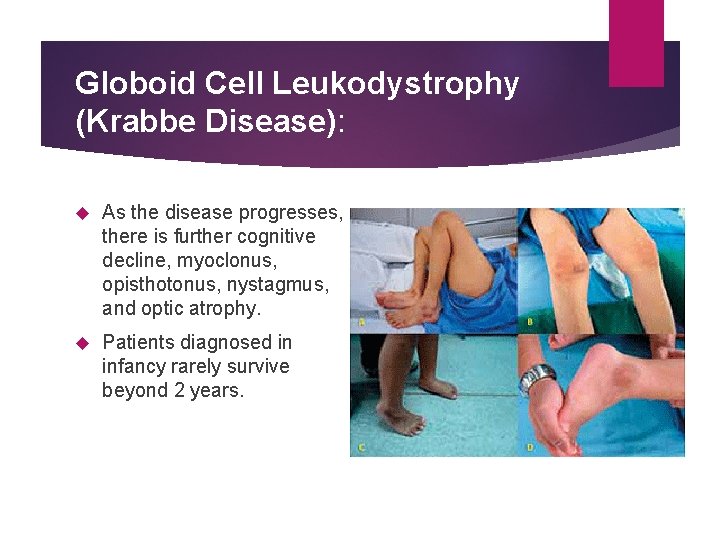 Globoid Cell Leukodystrophy (Krabbe Disease): As the disease progresses, there is further cognitive decline,