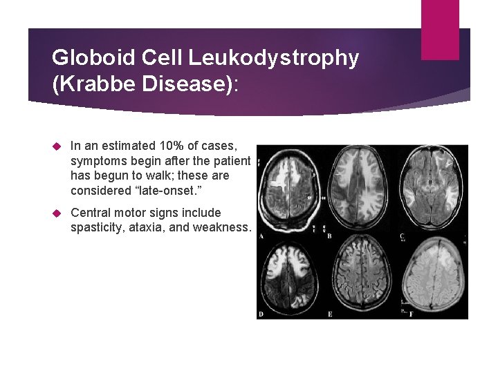 Globoid Cell Leukodystrophy (Krabbe Disease): In an estimated 10% of cases, symptoms begin after
