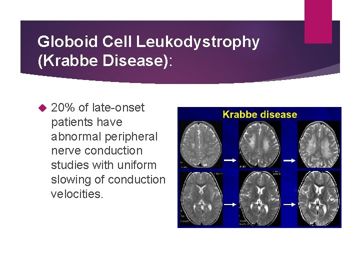 Globoid Cell Leukodystrophy (Krabbe Disease): 20% of late-onset patients have abnormal peripheral nerve conduction