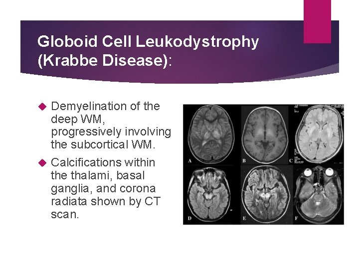 Globoid Cell Leukodystrophy (Krabbe Disease): Demyelination of the deep WM, progressively involving the subcortical