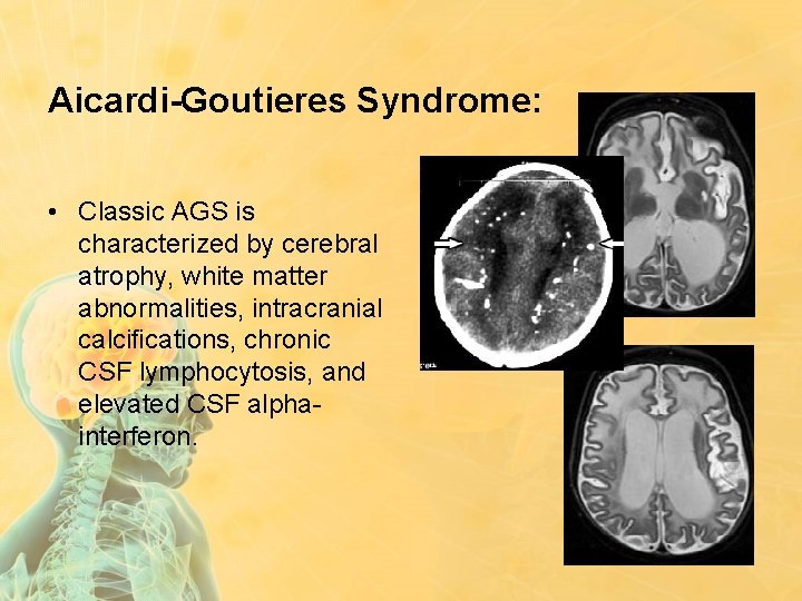 LEUKOENCEPHALOPATHIES ASSOCIATED WITH CALCIFICATIONS Mahvelati F MD Child