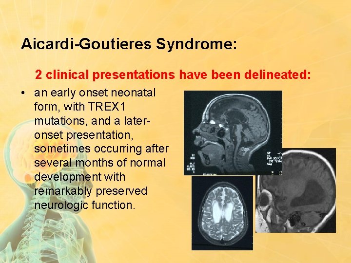 Aicardi-Goutieres Syndrome: 2 clinical presentations have been delineated: • an early onset neonatal form,