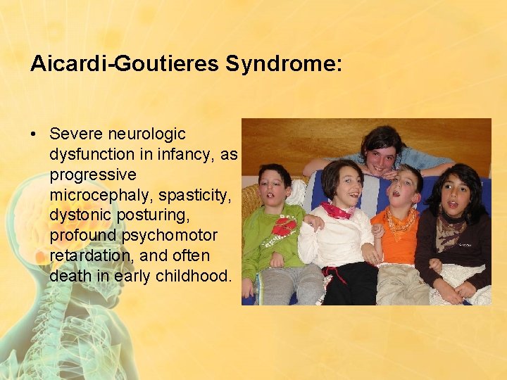 Aicardi-Goutieres Syndrome: • Severe neurologic dysfunction in infancy, as progressive microcephaly, spasticity, dystonic posturing,