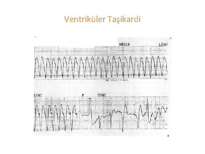 Ventriküler Taşikardi 