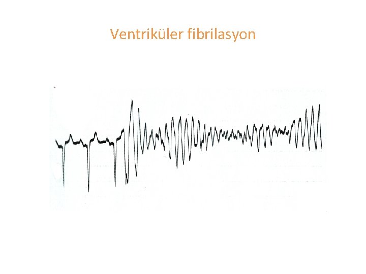 Ventriküler fibrilasyon 