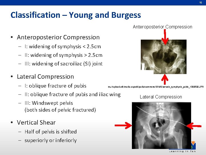 10 Classification – Young and Burgess Anteroposterior Compression • Anteroposterior Compression – I: widening 10 Classification – Young and Burgess Anteroposterior Compression • Anteroposterior Compression – I: widening