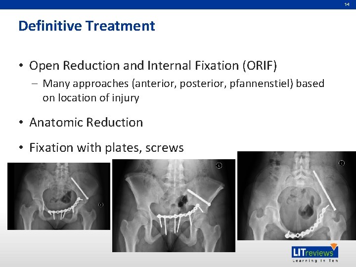 14 Definitive Treatment • Open Reduction and Internal Fixation (ORIF) – Many approaches (anterior, 14 Definitive Treatment • Open Reduction and Internal Fixation (ORIF) – Many approaches (anterior,