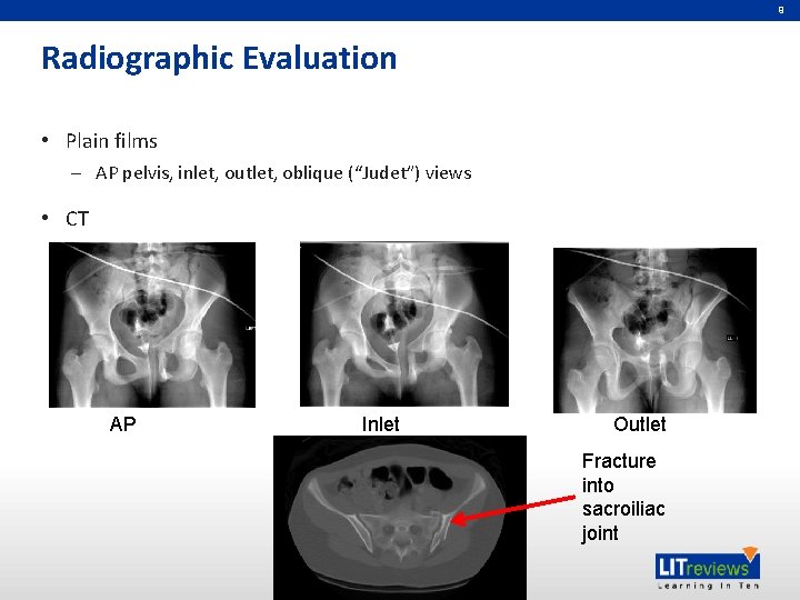 9 Radiographic Evaluation • Plain films – AP pelvis, inlet, outlet, oblique (“Judet”) views 9 Radiographic Evaluation • Plain films – AP pelvis, inlet, outlet, oblique (“Judet”) views