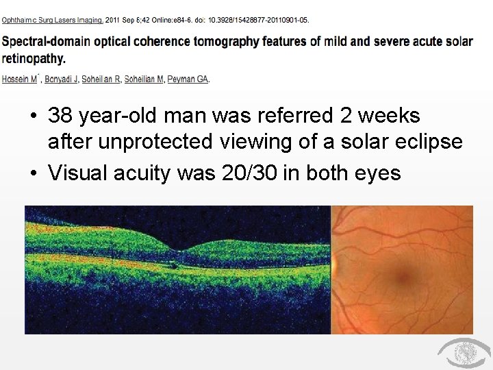  • 38 year-old man was referred 2 weeks after unprotected viewing of a