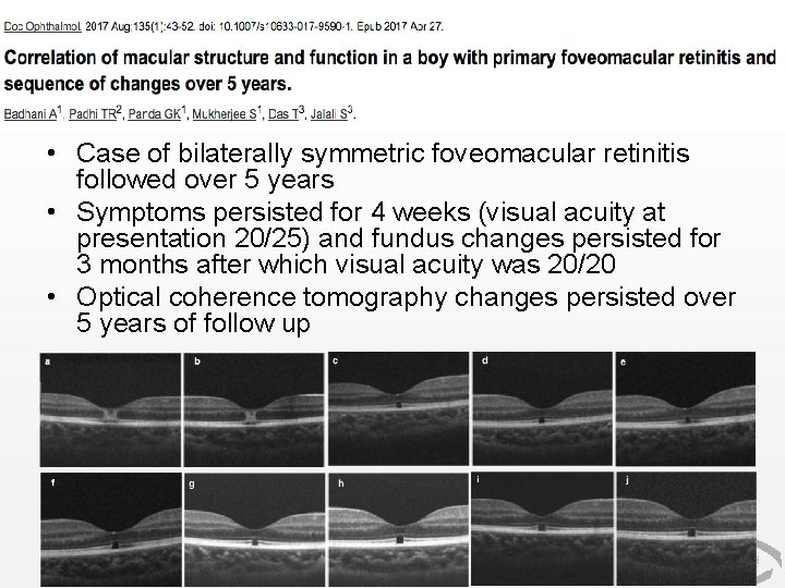  • Case of bilaterally symmetric foveomacular retinitis followed over 5 years • Symptoms